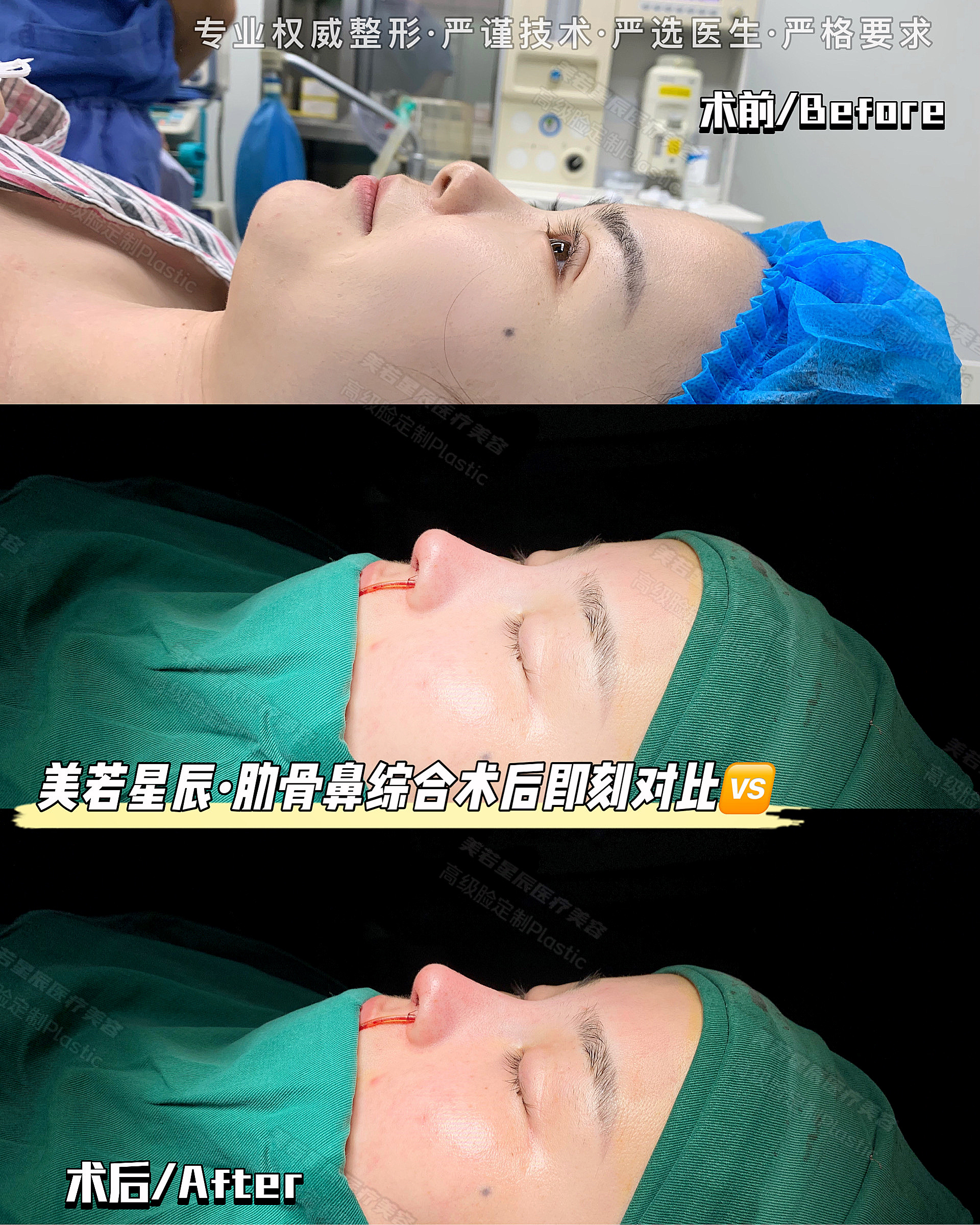 鼻整形手术多少钱,恢复期是多久_上海美若星辰医疗整形医院